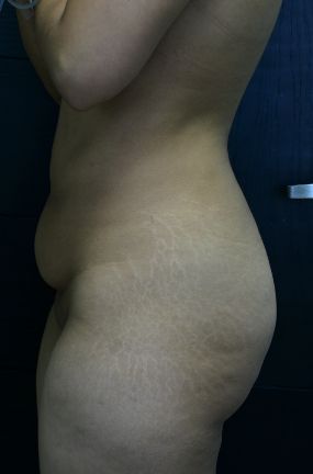 Tummy Tuck