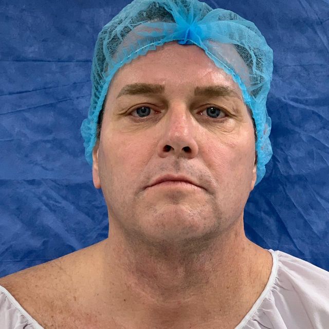 Full Facelift w/ Rhinoplasty