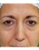 Blepharoplasty