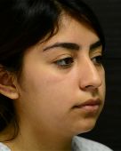 Rhinoplasty