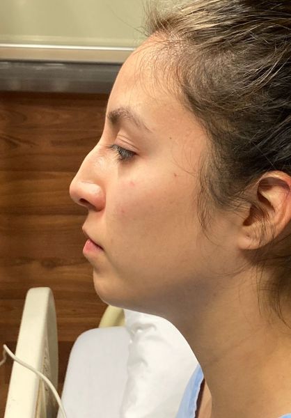 Rhinoplasty