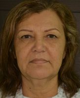 Facelift w/ Blepharoplasty