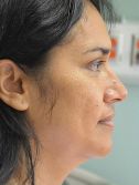 Facelift w/ Blepharoplasty