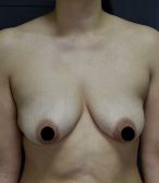 Breast Lift
