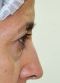 Blepharoplasty
