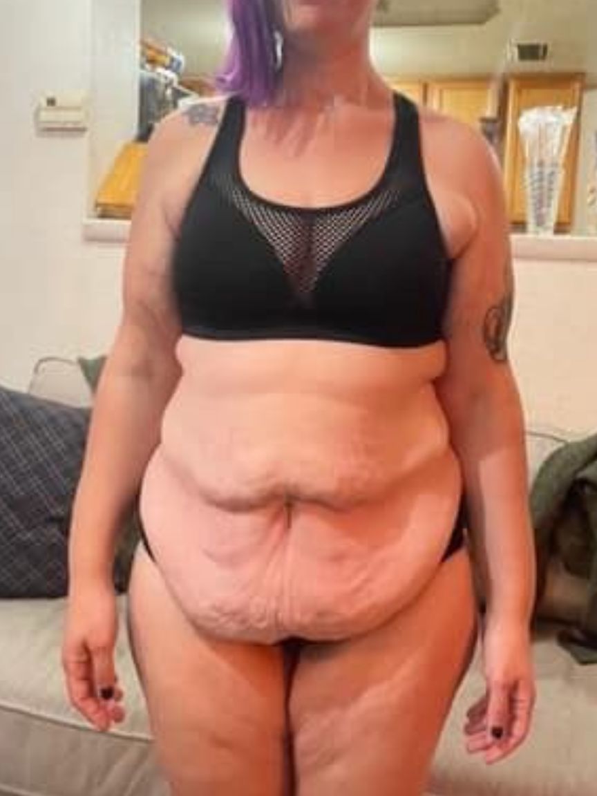 Tummy Tuck