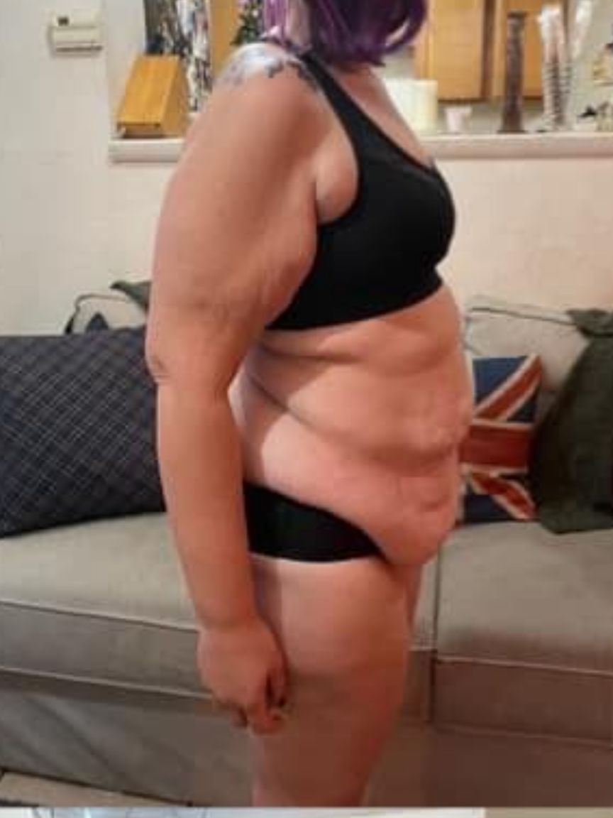 Tummy Tuck