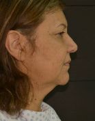 Facelift w/ Blepharoplasty