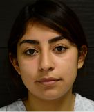 Rhinoplasty