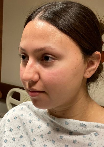 Rhinoplasty