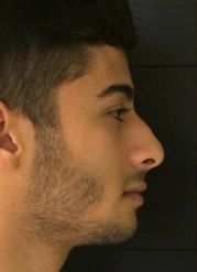 Rhinoplasty