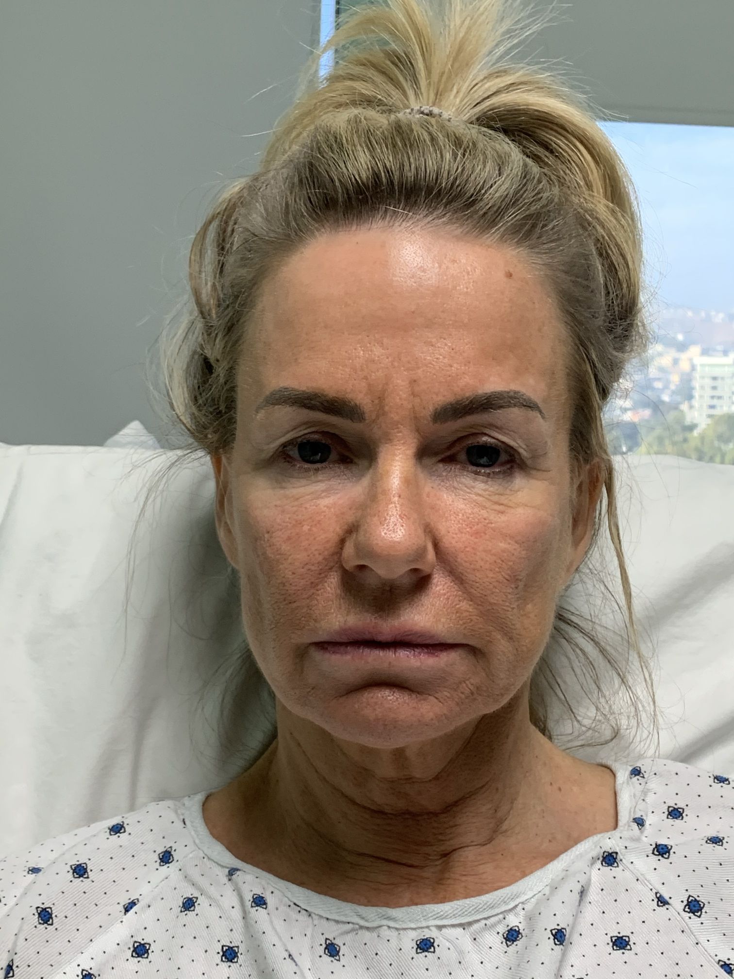 Full Face Lift w/ Eyelids