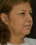 Facelift w/ Blepharoplasty