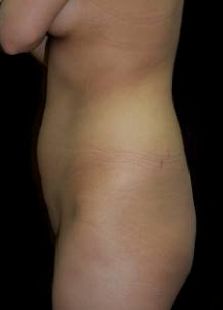 Liposuction w/ BBL