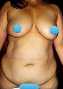 Tummy Tuck