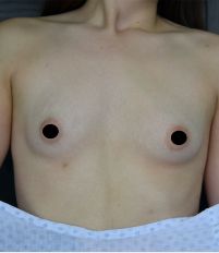 Breast Augmentation
