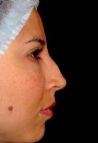 Rhinoplasty