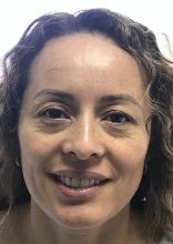 Facelift w/ Blepharoplasty