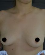 Breast Augmentation
