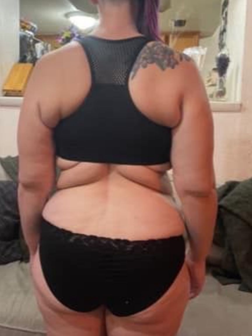 Tummy Tuck
