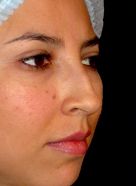 Rhinoplasty