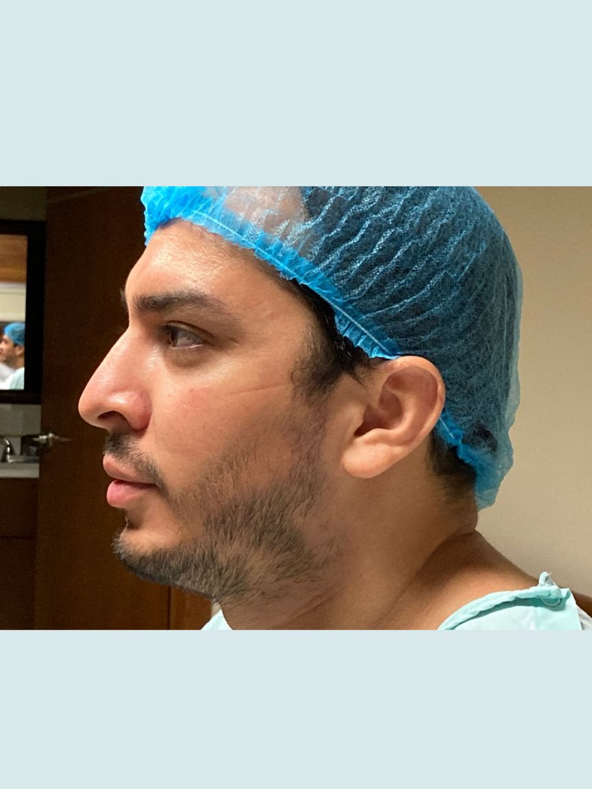 Rhinoplasty