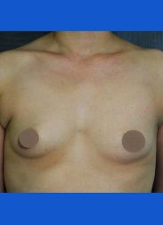 Breast Augmentation