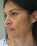 Facelift w/ Blepharoplasty