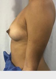 Breast Augmentation