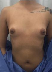 Breast Augmentation