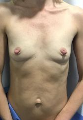 Breast Augmentation