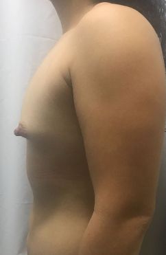 Breast Augmentation
