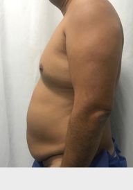 Tummy Tuck