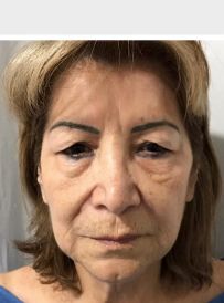 Full Face Lift w/ Eyelids