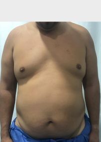 Tummy Tuck