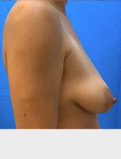 Breast Lift