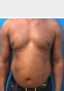 Liposuction