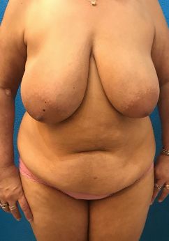 Mommy Makeover