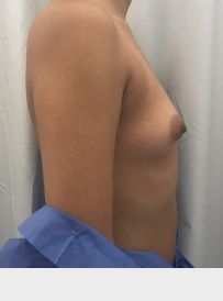 Breast Augmentation