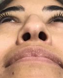 Rhinoplasty