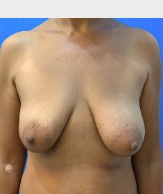 Breast Lift