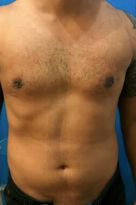 Liposuction