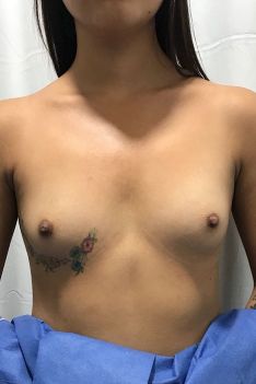 Breast Augmentation