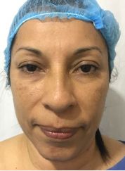 Rhinoplasty