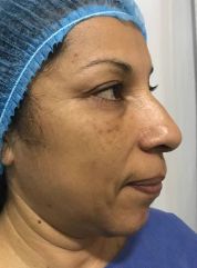 Rhinoplasty