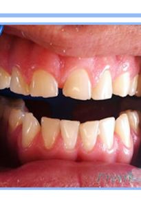 Oral Cosmetic Rehabilitation