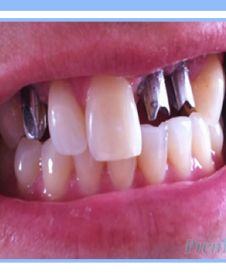 Multiple Dental Implants
