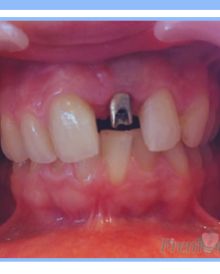 Single Dental Implant
