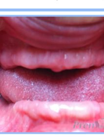 Overdenture 