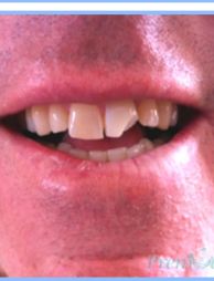 Oral Cosmetic Rehabilitation